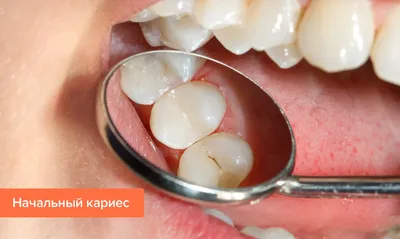 Начальный кариес зубов— стадии и методы лечения