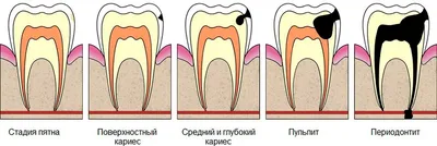 Лечение кариеса в Красноярске - Современная стоматология Петра Андреянова