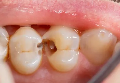 Aesculap - Глубокий кариес 🦷 ⠀ Кариес - это серьезное заболевание, которое  может возникнуть от, казалось бы, безобидного потемнения на зубе. Без  лечения кариес прогрессирует и развивается в опасные воспалительные  процессы, грозящие
