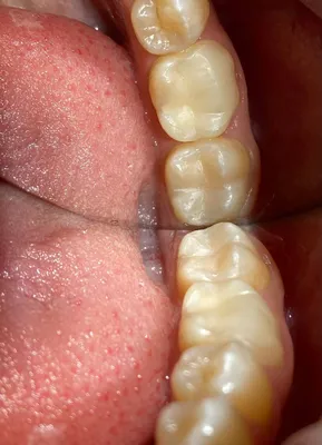Лечение зубов - кариеса и пульпита в стоматологической клинике «Корона» г.  Гатчина