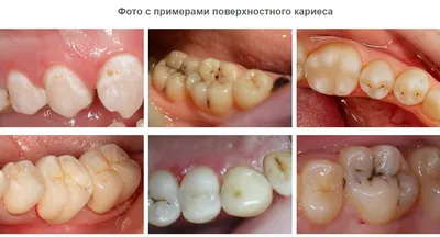 Лечение поверхностного кариеса зубов в Москве | Стоматологическая клиника  «Лаки Смайл»
