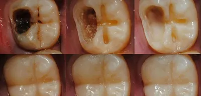 Глубокий кариес 37 зуба и замена пломбы на 36 зубе | Примеры работ - фото  до и после