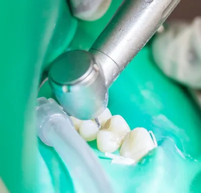 Лечение кариеса зуба | Безболезненное лечение кариеса в Химках - М23 Клиник