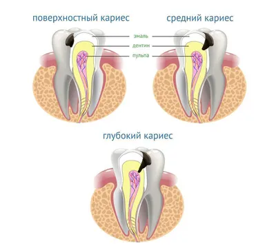 Лечение кариеса зубов » Стоматологическая клиника ЮАДЕНТ
