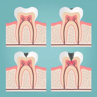 Кариес \"дырка\" в зубе. Как обнаружить и зачем нужен рентгеновский снимок?  Некариозные поражения. | Правдивая стоматология доктора Аболмасова | Дзен