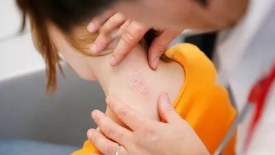 Лечение псориаза кожи рук в клинике в Москве