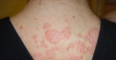 On Clinic Bishkek - ☝Делимся результатами лечение псориаза На фото  пациентка до и после лечения. 👆Псориаз — это хроническое неинфекционное  заболевание, которое поражает в основном кожу. 👆Он имеет разные виды и  форму,
