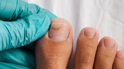 Начинающийся грибок ногтей на ногах фото фото