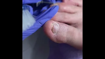 Грибок ногтя после гематомы - Вопрос дерматологу - 03 Онлайн