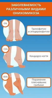 Воспаление ногтя – цены на лечение воспаления ногтя большого пальца на ноге  и руке в Москве | Клиника Полёт