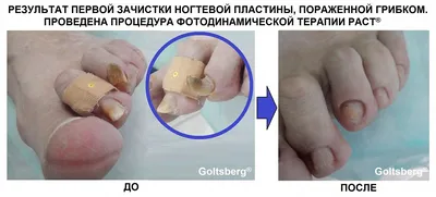 Грибок ногтей на ногах, чем лечить. Центр подологии Goltsberg