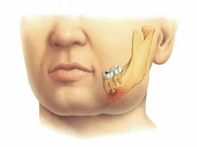 Лечение воспаления надкостницы зуба после удаления зуба мудрости
