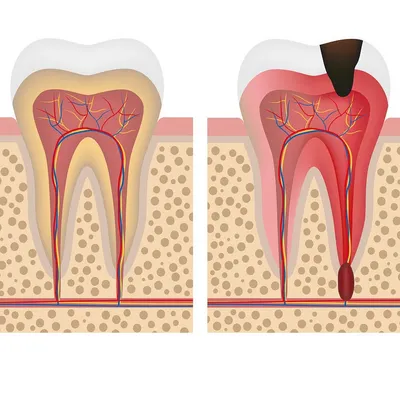 Воспаление корня зуба: качественное лечение в Минске
