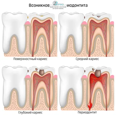 Лечение острого гнойного периодонтита стоимость в Москве