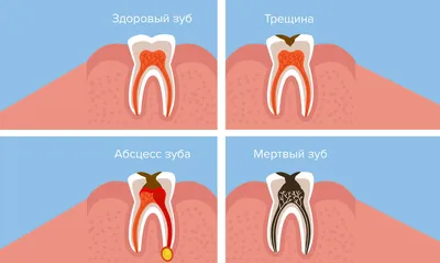 Лечение периостита челюстей