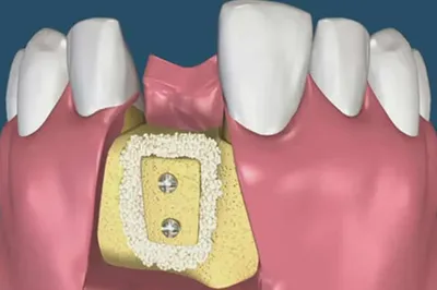 Костная пластика при имплантации зубов - Cтоматология Май