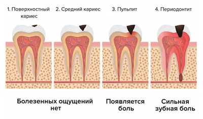 Периодонтит - что это, осложнения, лечение -