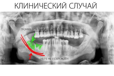 Воспаление надкостницы зуба: симптомы и лечение