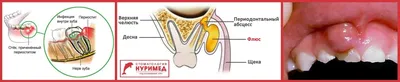 Периостит симптомы, диагностика, лечение