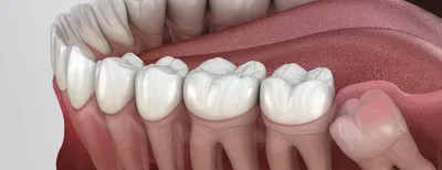 Удаление ретинированных зубов мудрости | dentalmir.ru