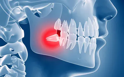 Перикоронит: симптомы, лечение