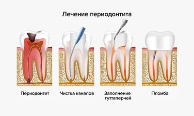 Удаление зубов в Омске