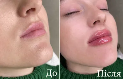 Процедура по увеличения губ техники и результаты. Фото - Косметология  доктора Корчагиной