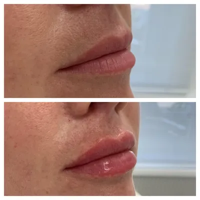 Хейлопластика - пластика губ, омоложение губ. Новая Мировая Хирургия