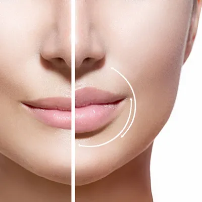 Увеличение губ с помощью подъемных нитей — новый тренд в косметологии |  Быть в социуме, но не в толпе. | Дзен