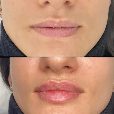 Увеличение губ гиалуроновой кислотой: фото до и после, отзывы специалистов,  как проходит процедура
