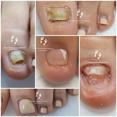 Последствия наращивания ногтей у мастеров педикюра при ониходистрофии |  Московская Клиника Подологии