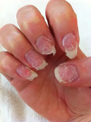Ногти после наращивания: 100 фото вариантов лечения, восстановления и  обновления ногтей