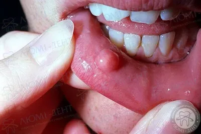 При прорезывании зуба торчит нарост кожи у ребенка. Кто сталкивался? -  Советчица