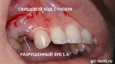 Шишка на десне, что делать? - Полезные статьи на сайте стоматологической  клиники Церекон