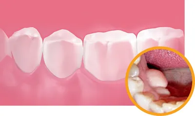 Шатается коренной зуб, болит зуб, гноится десна? Скрипите во сне зубами?  Основные симптомы стоматологических заболеваний