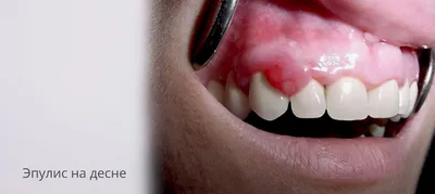Шишка на десне после установки импланта - Полезные статьи на сайте  стоматологической клиники Церекон