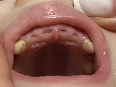 Лечение экзостоза после удаления зуба