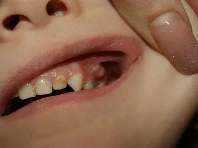 Нарост на десне у ребенка - Вопрос стоматологу - 03 Онлайн