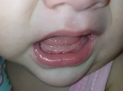 Нарост на десне у ребенка - фото эпулиса, симптомы при прорезывании зубов,  лечение