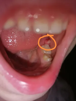 Папиломообразный нарост на десне ребенка - Вопрос стоматологу - 03 Онлайн