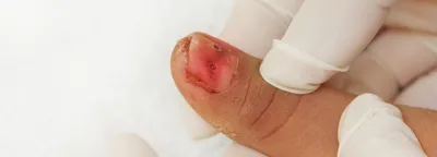 Травма ногтя на руке или ноге - лечение и восстановление после