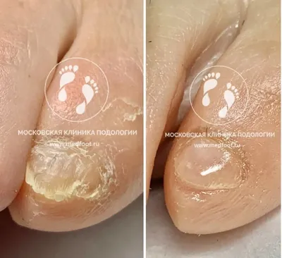 Изменение ногтевых пластин мизинцев | Московская Клиника Подологии