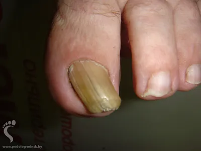 Утолщенные ногти на ногах: профилактика и лечение от профессионального  подолога в Минске