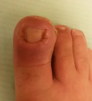 Лечение вросшего ногтя на большом пальце ноги, операция по удалению  вросшего ногтя на ногах