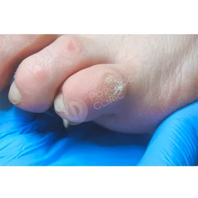 Почему болят ногти на ногах? — болит ноготь на большом пальце ноги, причины  боли и черноты ногтя на ноге