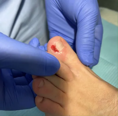 Почему боль свидетельствует об активном росте ногтя?