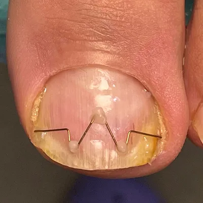 Отсутствие ногтя после травмы — как лечить? |