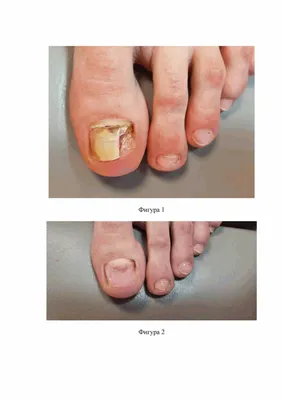 Экстензия большого пальца (Hallux extensus): деформация первого пальца ноги  в сагиттальной плоскости - Institut Català del Peu