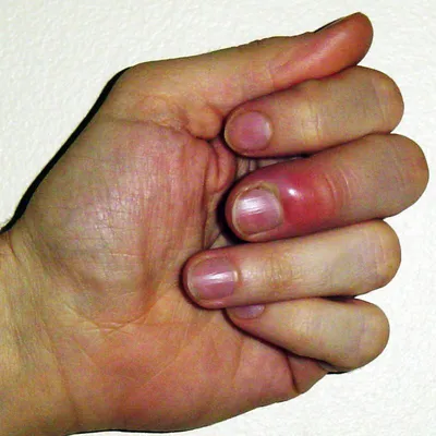 Нарост на пальце руки у ногтя фото фото