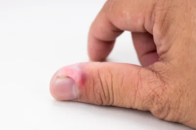 Паронихия пальца: лечение консервативными методами и хирургическое —  клиника «Добробут»